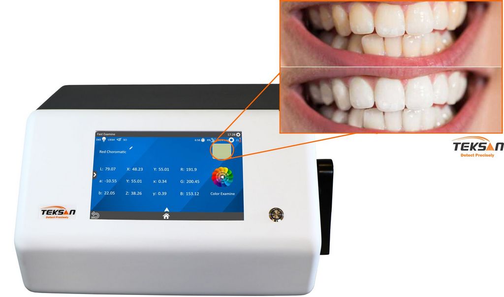مقایسه رنگ دندان بعد از به کار بردن محصولات سفید کننده دندان